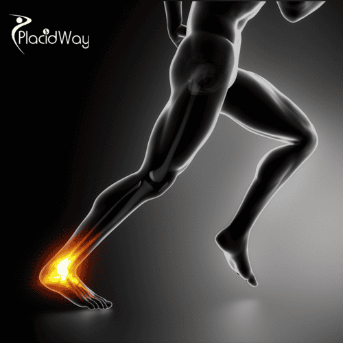 Achilles Tendon Repair in Mexico: Advanced Care for Australian Patients 